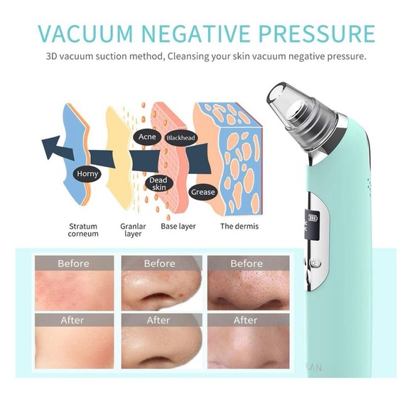 BRAND NEW Blackhead Remover T Zone Pore Vacuum Cleaner - Picture 6 of 9